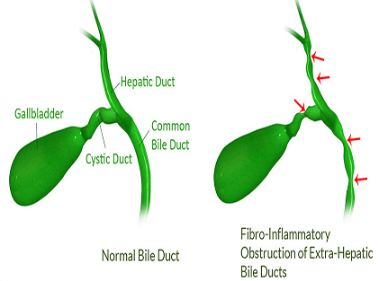 Biliary Atresia Diagram
